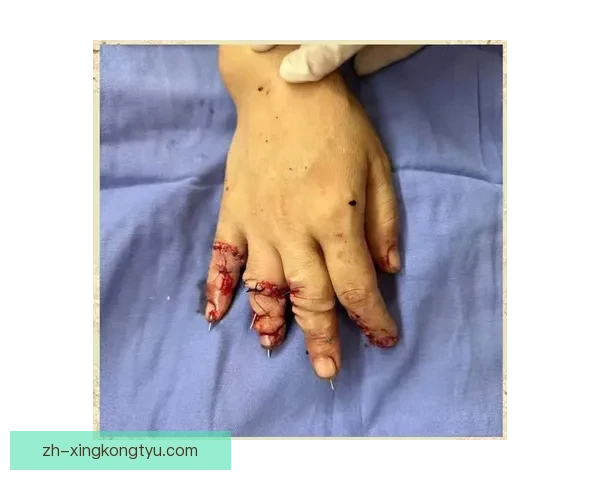 拙劣玻璃人夸西22分钟四伤